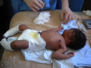 A one-day-old infant born with clubfeet is treated using the Ponseti casting method.