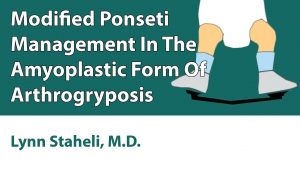 Modified Ponseti Management In The Amyoplastic Form Of Arthrogryposis