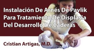 Instalación De Arnés De Pavlik Para Tratamiento De Displasia Del Desarrollo De Caderas