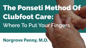The Ponseti Method Of Clubfoot Care׃ Where To Put Your Fingers